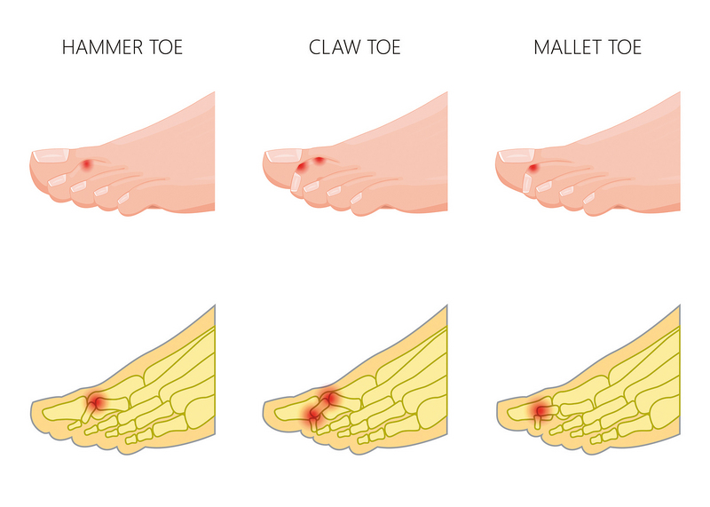 ●要判斷病人是患上槌狀趾、錘狀趾，抑或是爪狀趾，需通過臨?檢查是哪一節腳趾關節出現彎曲變形。