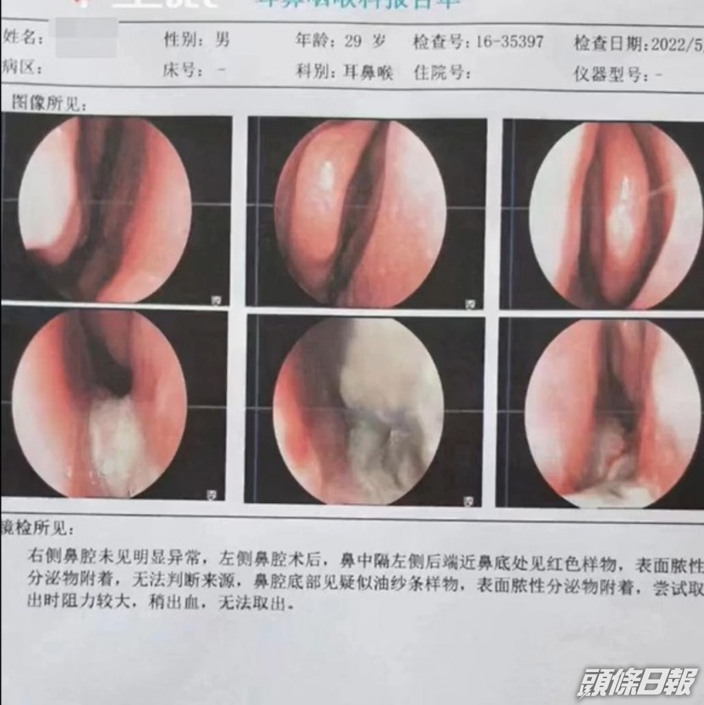 醫院做了檢查照出鼻內有長修形物體。網圖