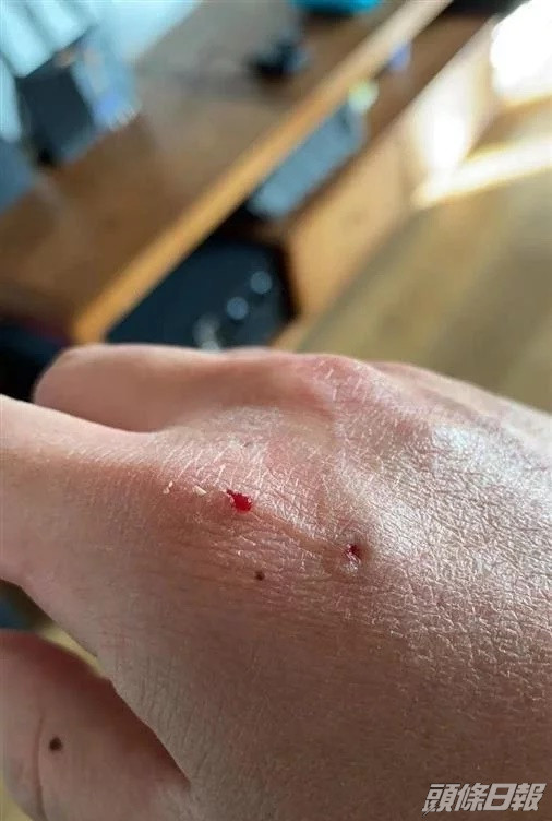 沈先生的手被咬傷。互聯網圖片