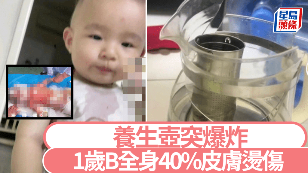 養生壺離奇爆炸致1歲小孩嚴重燙傷。抖音@王倩