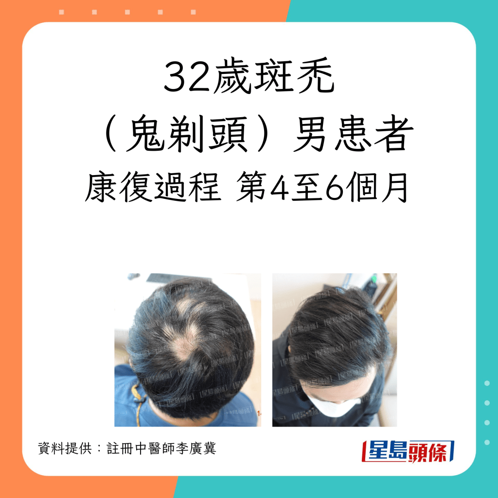32歲脫髮（鬼剃頭）男患者康復過程，經中醫治療第4至6個月