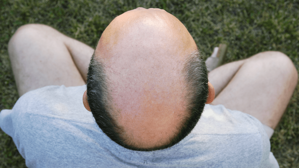 脫髮原因｜40歲起禿頭率高達60% 吃1類食物易脫髮 醫生教4招護髮
