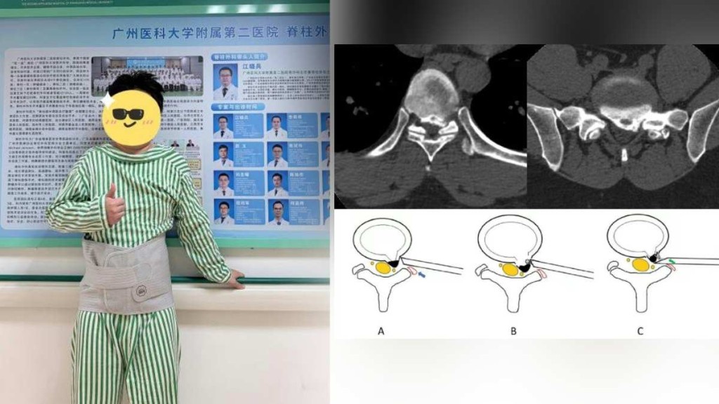 广州牙医邓先生用枕头垫腰纾缓痛楚，但睡醒后却下肢瘫痪大小便失禁。广医二院