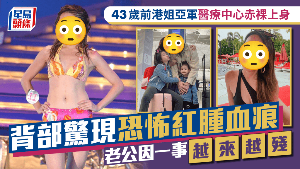 43歲前港姐亞軍醫療中心赤裸上身 背部驚現恐怖紅腫血痕 老公因一事越來越殘