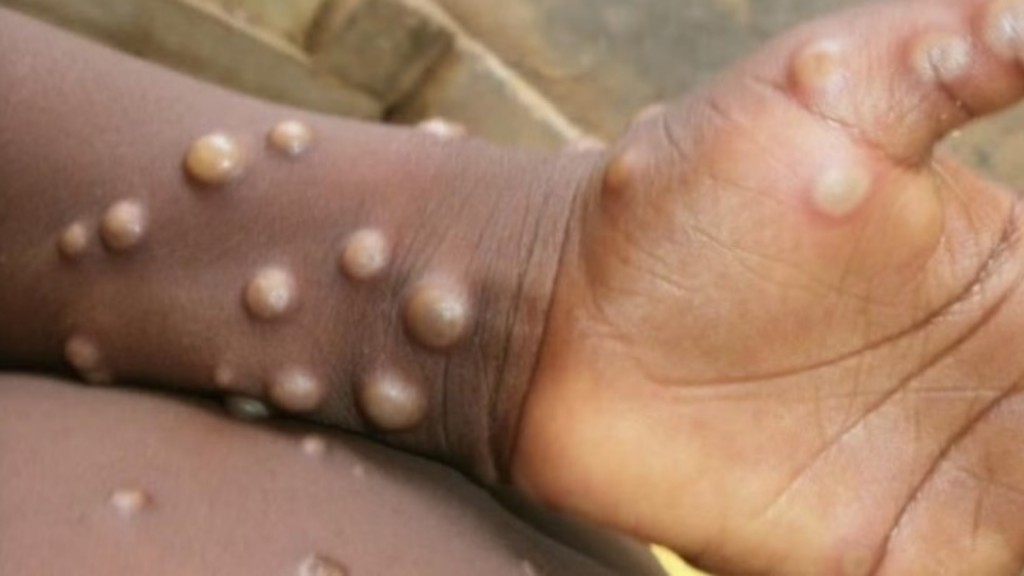 猴痘疫情繼續在全球蔓延。圖:WHO