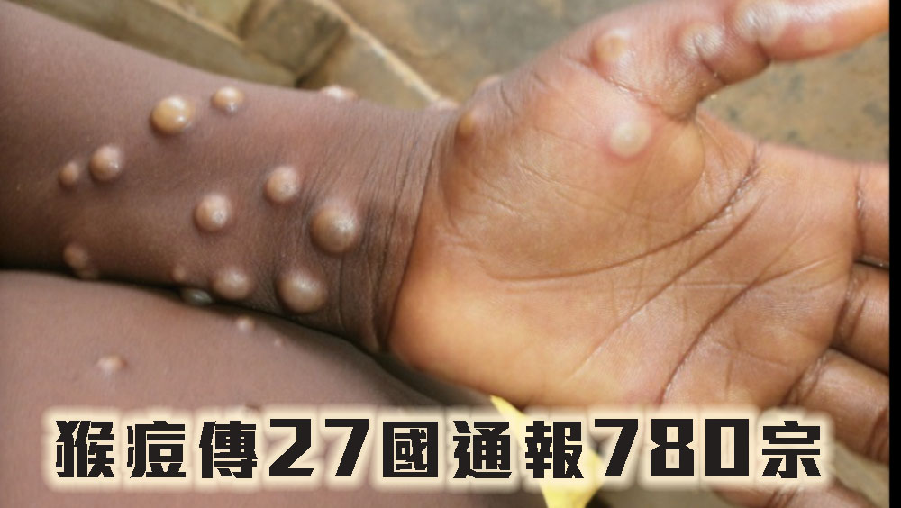 猴痘傳27國通報780宗,世衞維持風險中等。WHO