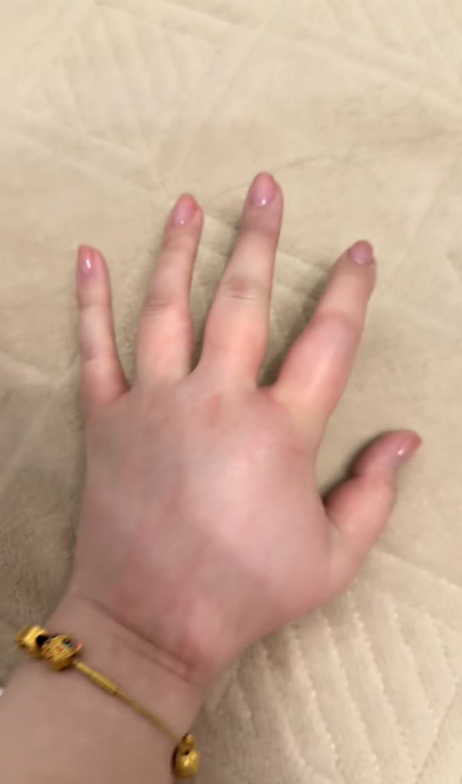 江蘇女子喂微毒的豬鼻蛇被咬，手腫如氣球。抖音