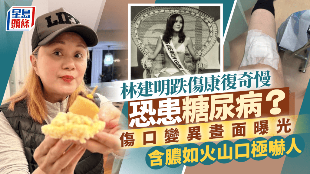 71歲林建明跌傷康復奇慢恐患糖尿病？  傷口變異畫面曝光  含膿如火山口極嚇人