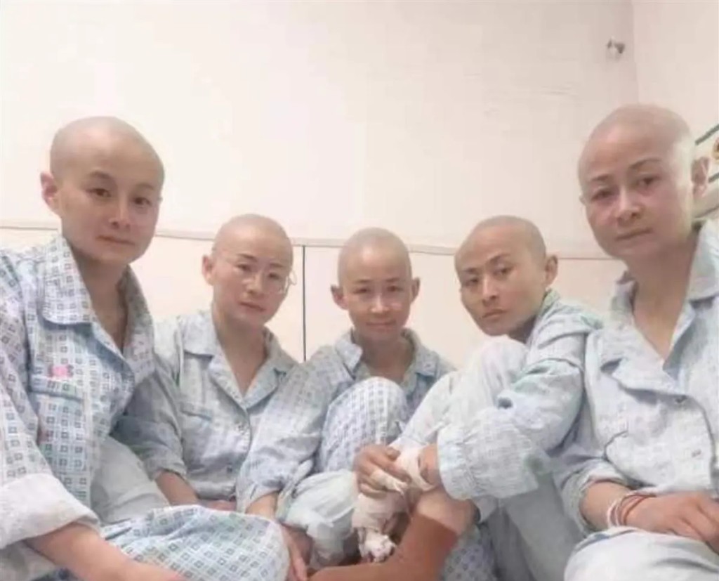 姐弟母親與其他姊妹剃光頭，為外甥捐出皮膚。