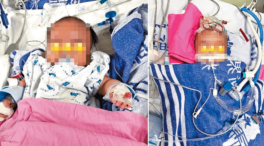 盧先生指兒子「細波」早前已接受手術，現時留醫兒童深切治療部。