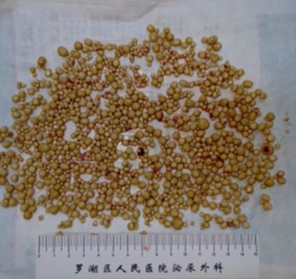 深圳有老翁膀胱藏有逾1200粒結石，情況罕見。新京報