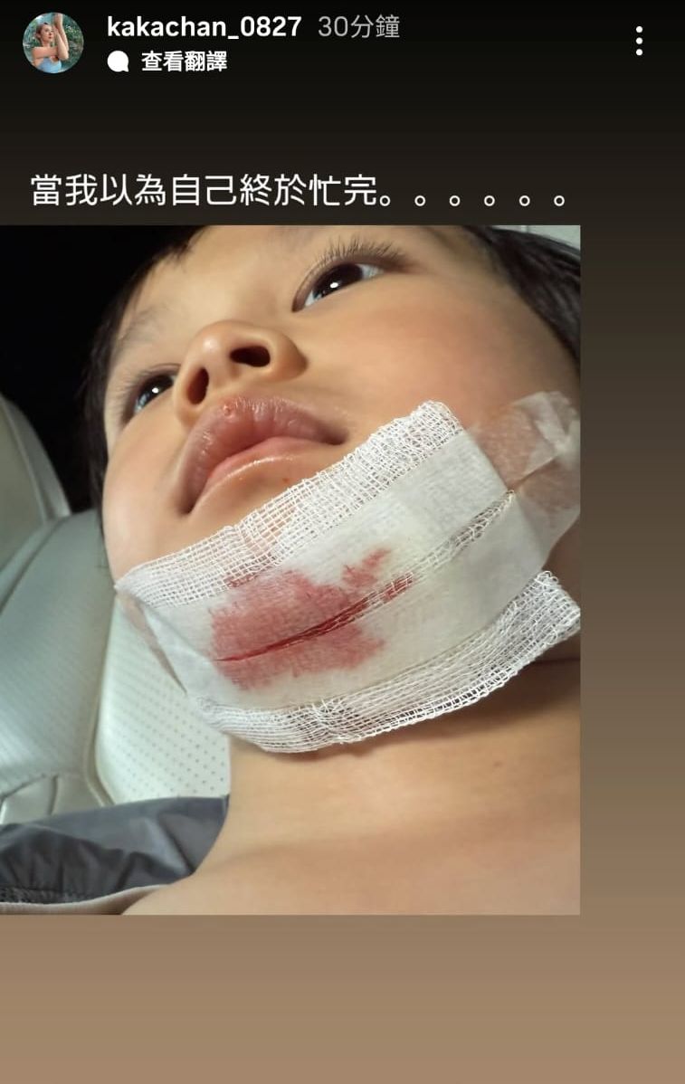 陳渃晴今日自爆不慎受傷,見到下巴出晒血。 陳渃晴今日自爆不慎受傷,見到下巴出晒血。