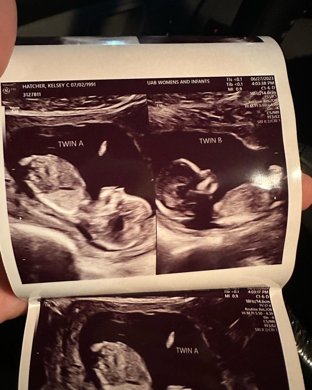 超聲波檢查發現海契爾兩個子宮同時懷孕。IG