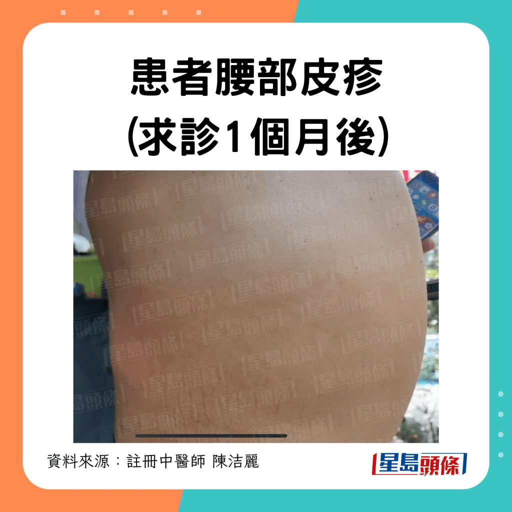 1個月後腰部皮診