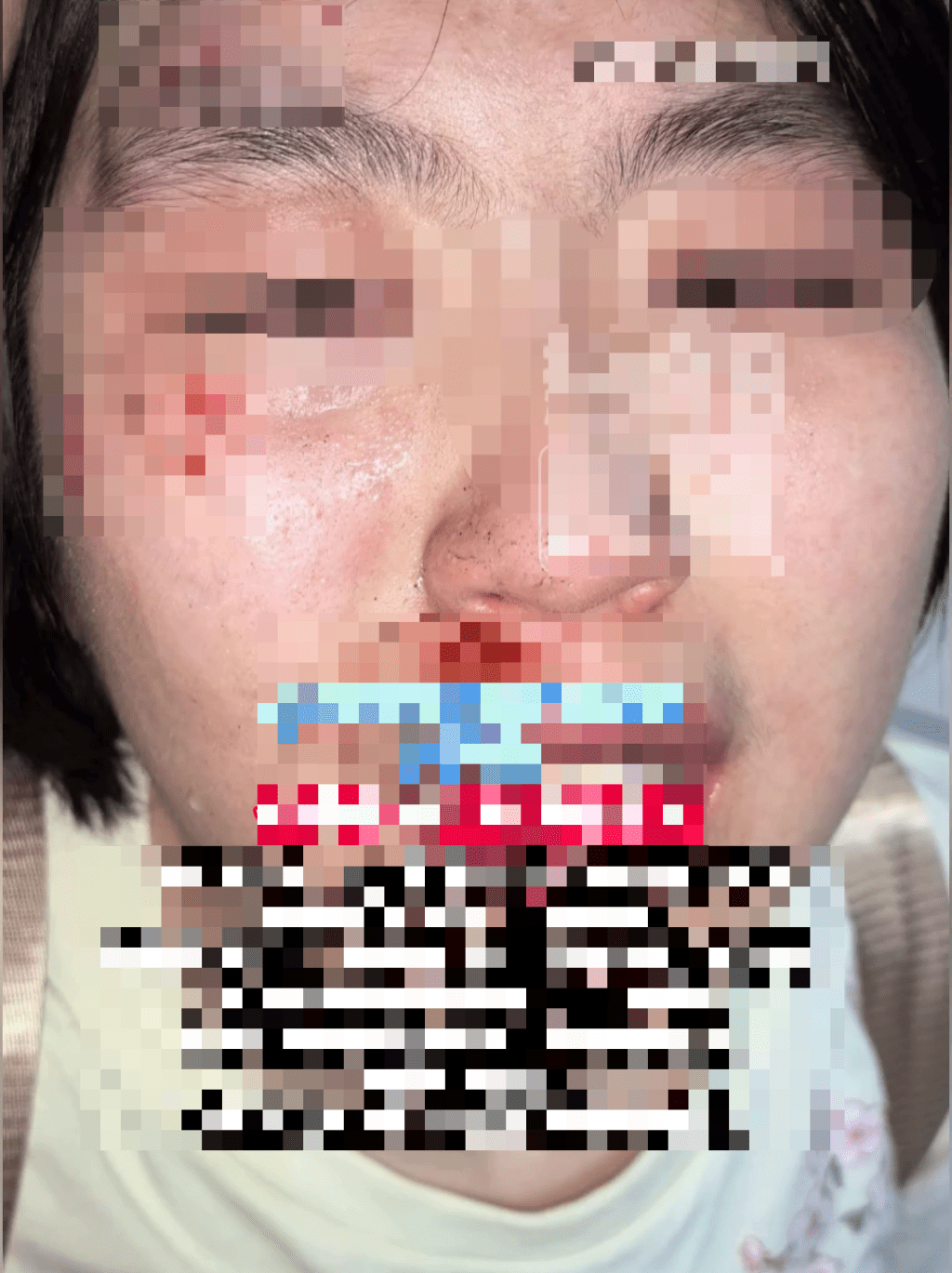 少女被打后血流披脸，伤痕累累。