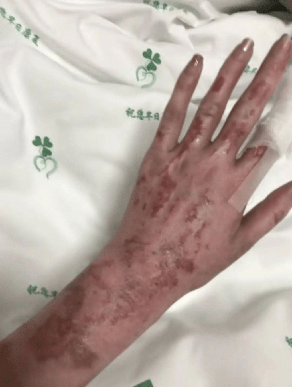 童瑤（佟女士）的手部傷情。