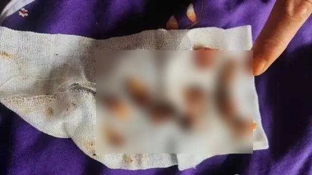 老李被口腔醫院過度醫療,一次過拔光全口12顆牙齒。 老李被口腔醫院過度醫療,一次過拔光全口12顆牙齒。