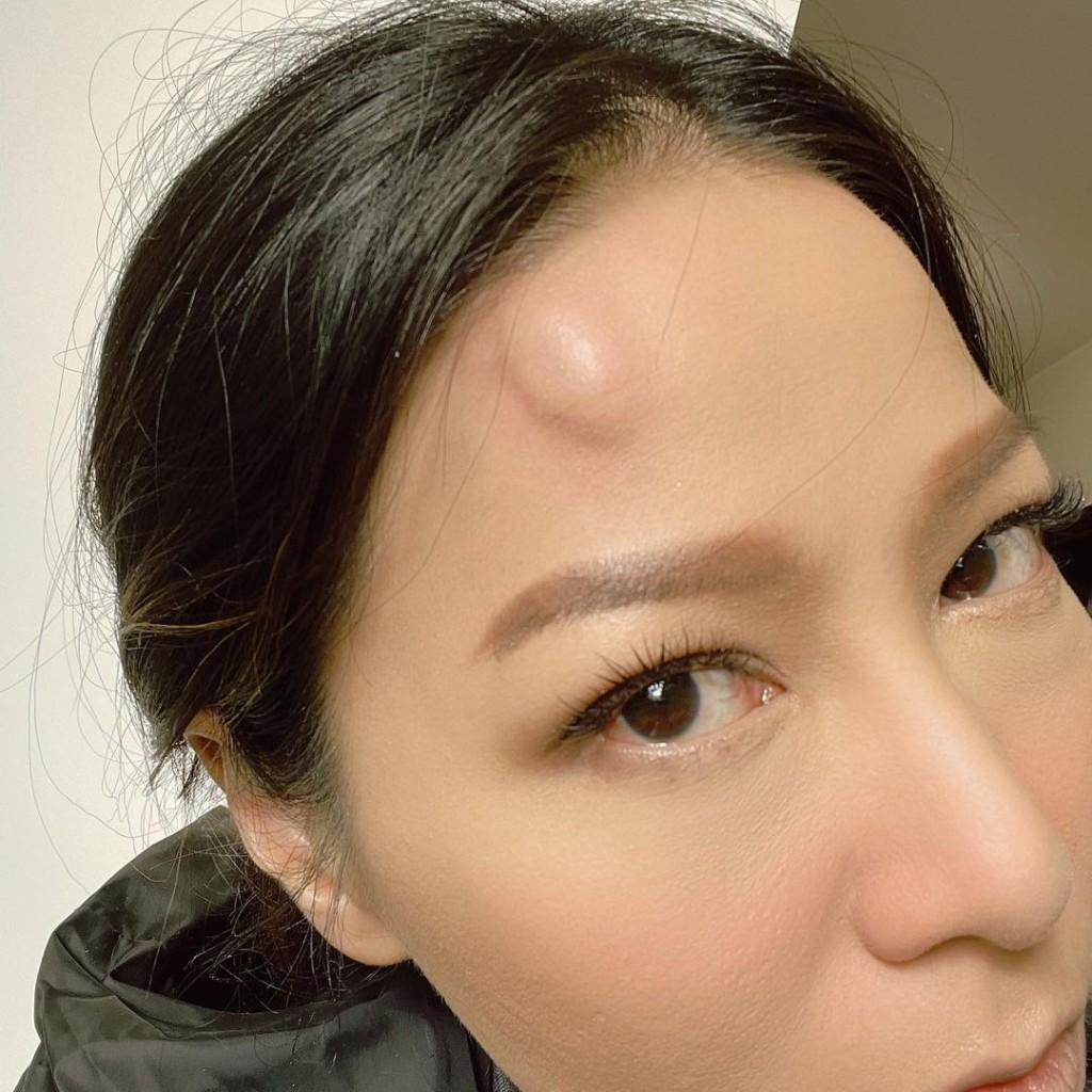 阿滕今次不小心撼頭埋牆，額頭腫起如鵪鶉蛋般，令人心痛。