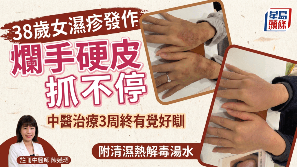 38岁女慢性湿疹烂手硬皮抓不停 中医治疗3周终有觉好瞓 中医分享清湿热解毒汤水