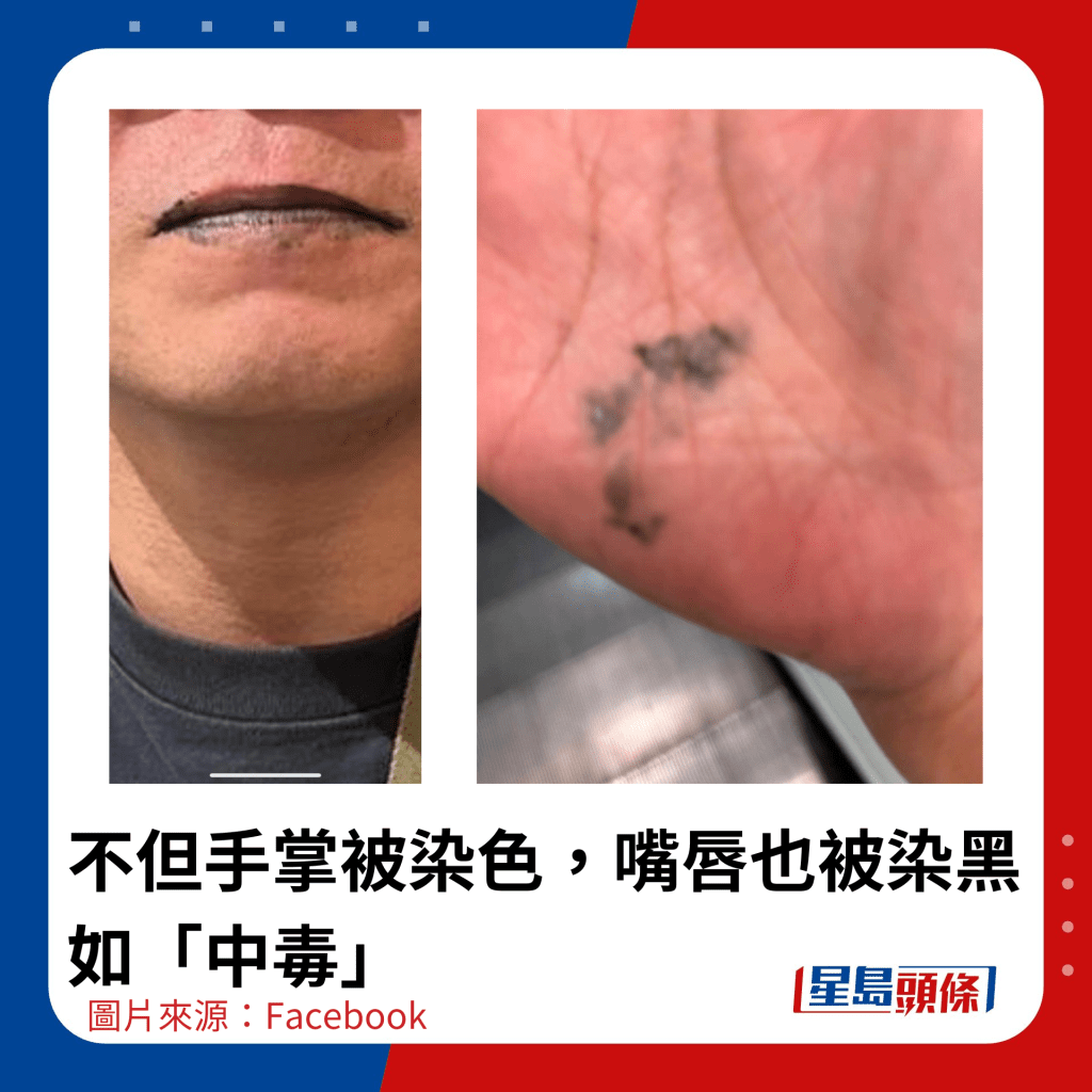 不但手掌被染色，嘴唇也被染黑如「中毒」