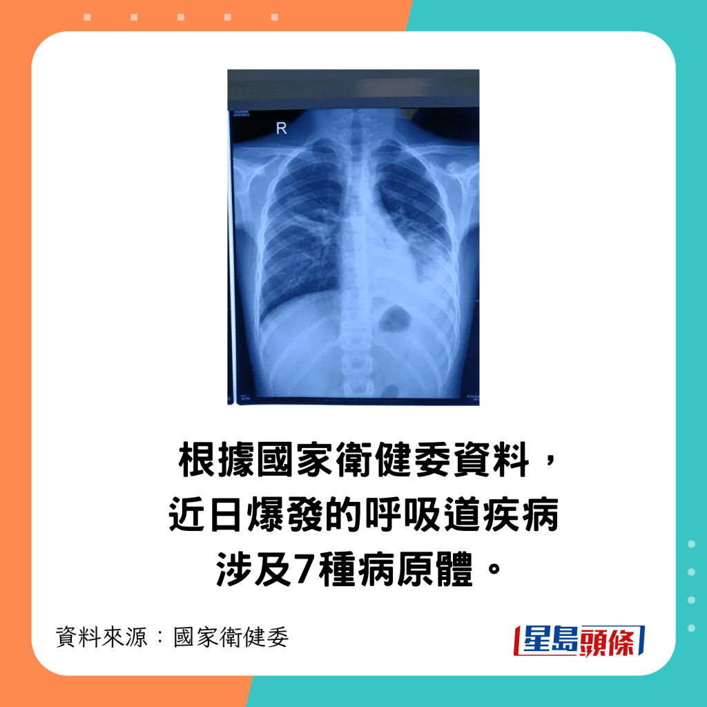 近日爆發的呼吸道疾病涉及7種病原體