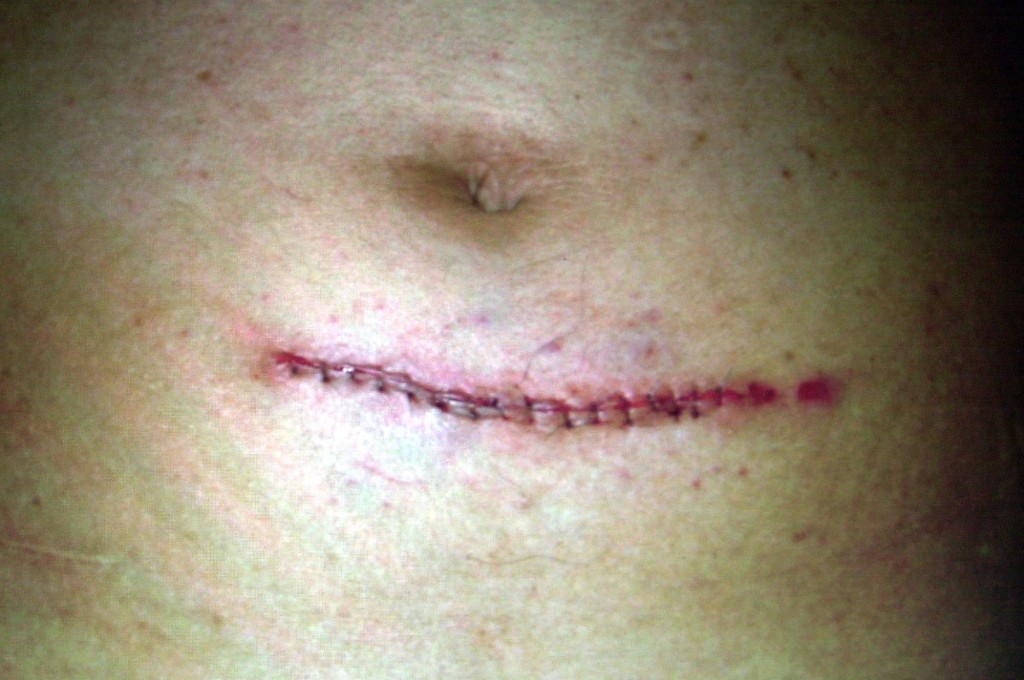 醫生替陳水扁腹部縫了十多針，所幸只是皮肉傷。 美聯社