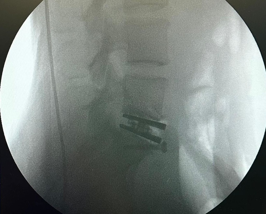 徐濠萦因为多年来腰痛，获医生建议进行椎间盘置换手术。