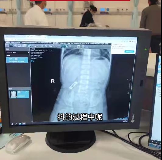 安徽有1歲女童誤吞3厘米長髮夾，靠食韭菜、金針菇成功排出體外。篝火視頻