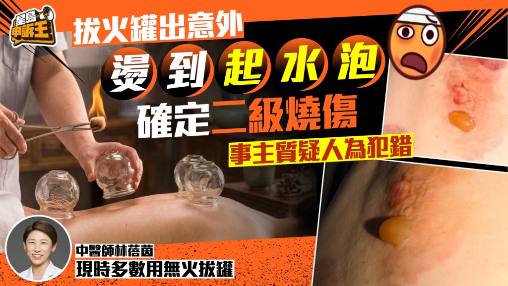 星島申訴王 | 拔火罐出事意外 燙到起水泡 事主確定二級燒傷 需洗傷口兩星期