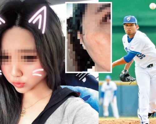 黃勝雄因出軌一事不時與太太（左）吵架，更出手打對方，令太太的視網膜脫落，面部紅腫。
