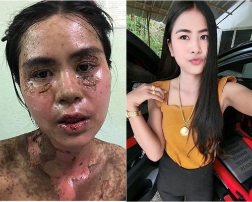 凱可涵因牙痛,自行服食止痛藥後出現過敏,全身脫皮疼痛,要送院治理。事主 Facebook