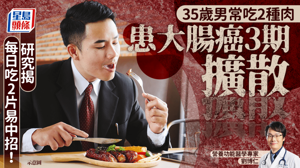 大腸癌｜35歲男常吃2種肉 患大腸癌3期兼擴散 研究揭日吃2片易中招