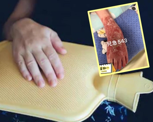 暖水袋分分鐘存在燙傷風險。網圖