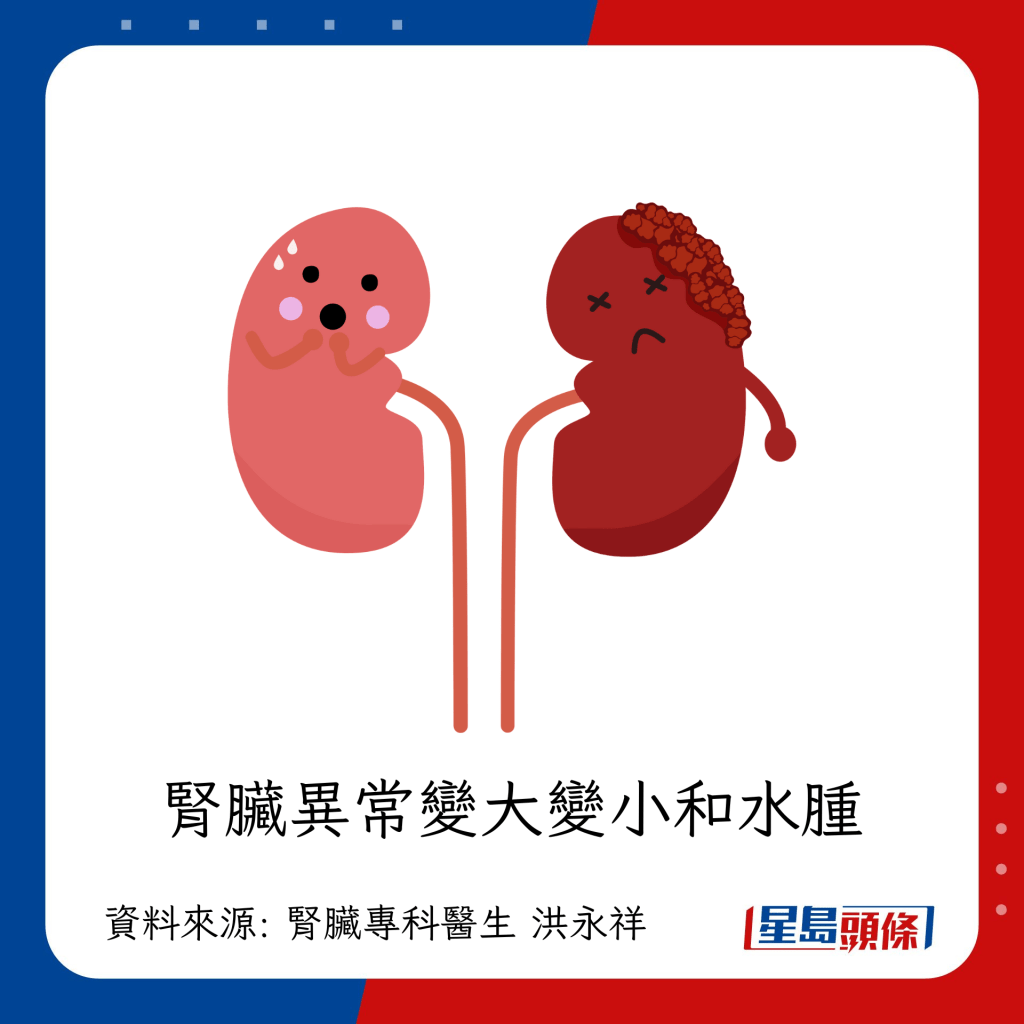 腎功能變差的症狀：腎臟異常變大變小和水腫
