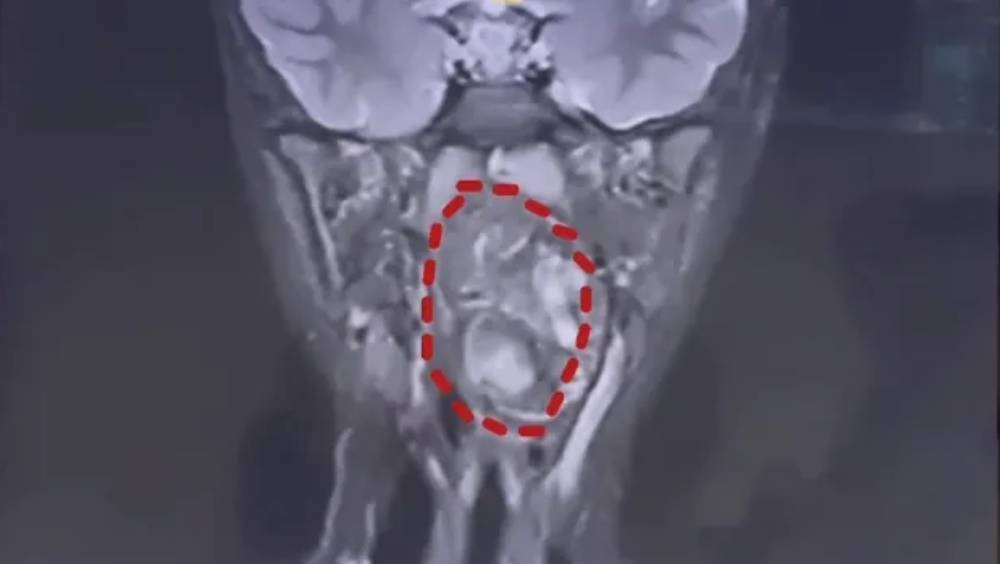 6歲童喉藏「雙胞胎」畸胎瘤。 