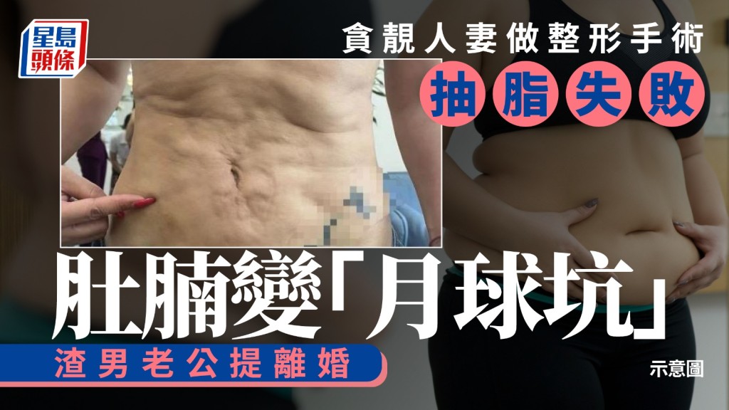 貪靚人妻肚腩變「月球坑」，老公要求離婚。