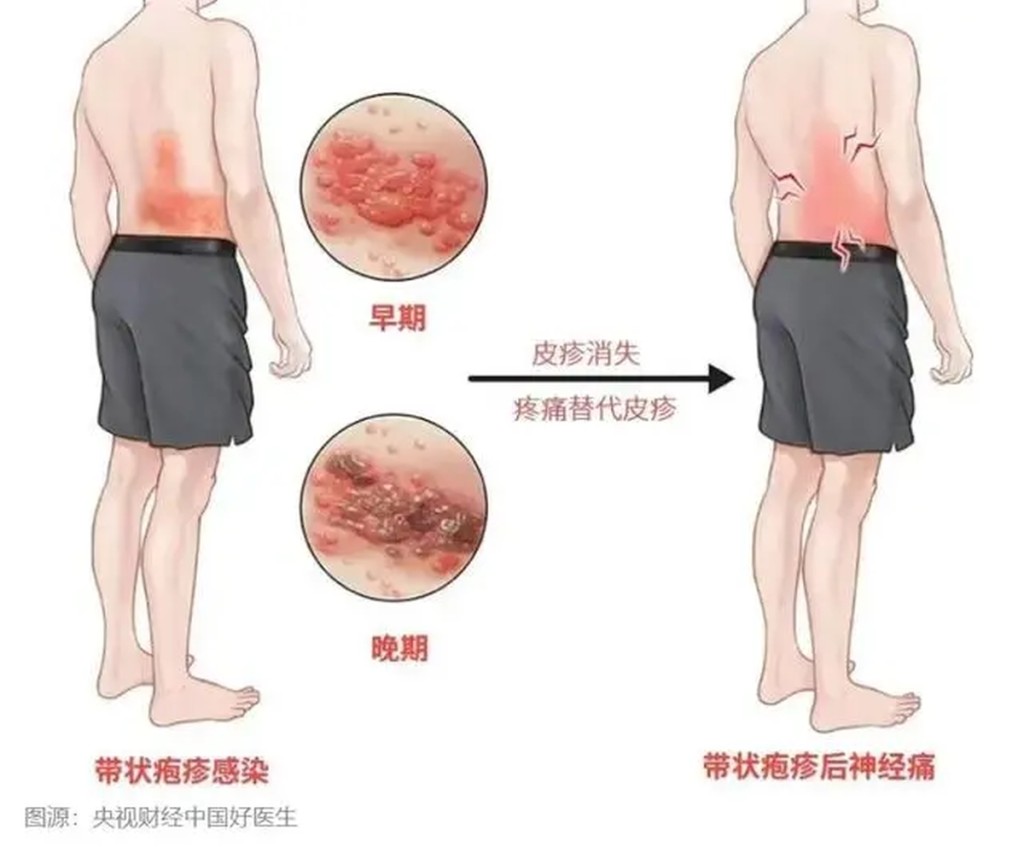 很多患者在皰疹乾燥、結痂後會遺留纏綿日久的併發症——帶狀皰疹後神經痛。