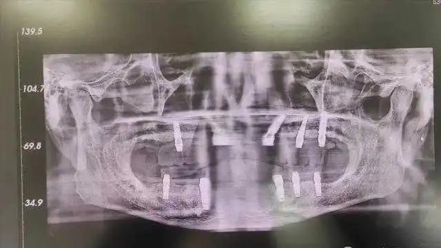 老李被口腔醫院過度醫療,一次過拔光全口12顆牙齒。 老李被口腔醫院過度醫療,一次過拔光全口12顆牙齒。
