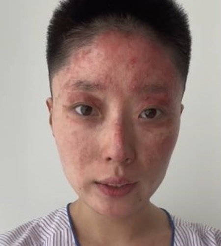 童瑤有毀容危險。 童瑤有毀容危險。