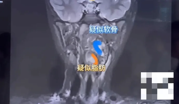 畸胎瘤有脂肪有軟骨。