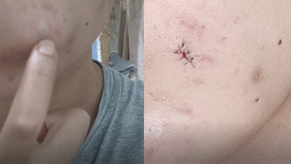 福建女子擠暗瘡致臉部感染,須做手術縫了6針。