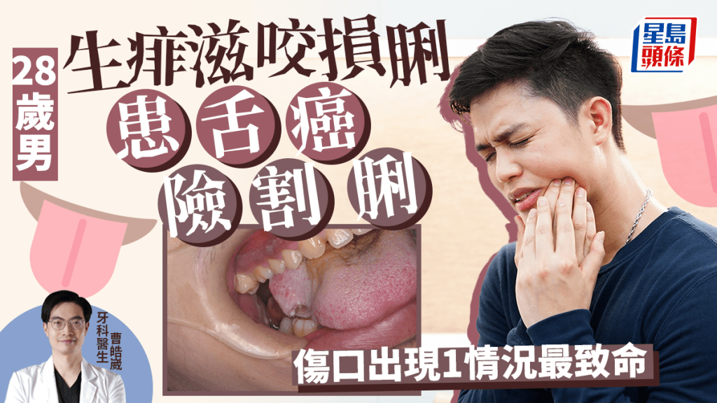 28歲男生痱滋患舌癌險割脷，傷口出現1情況致命率高