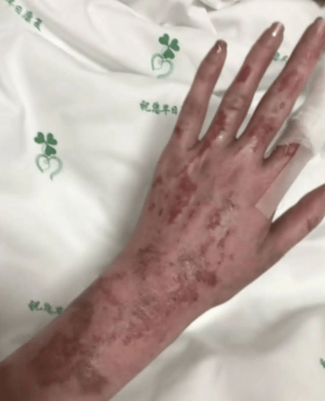 童瑤大幅度燒傷。 童瑤大幅度燒傷。