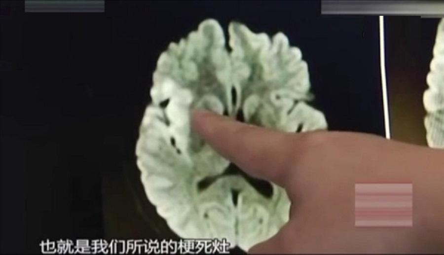 病人出現腦梗死(中風)現象。