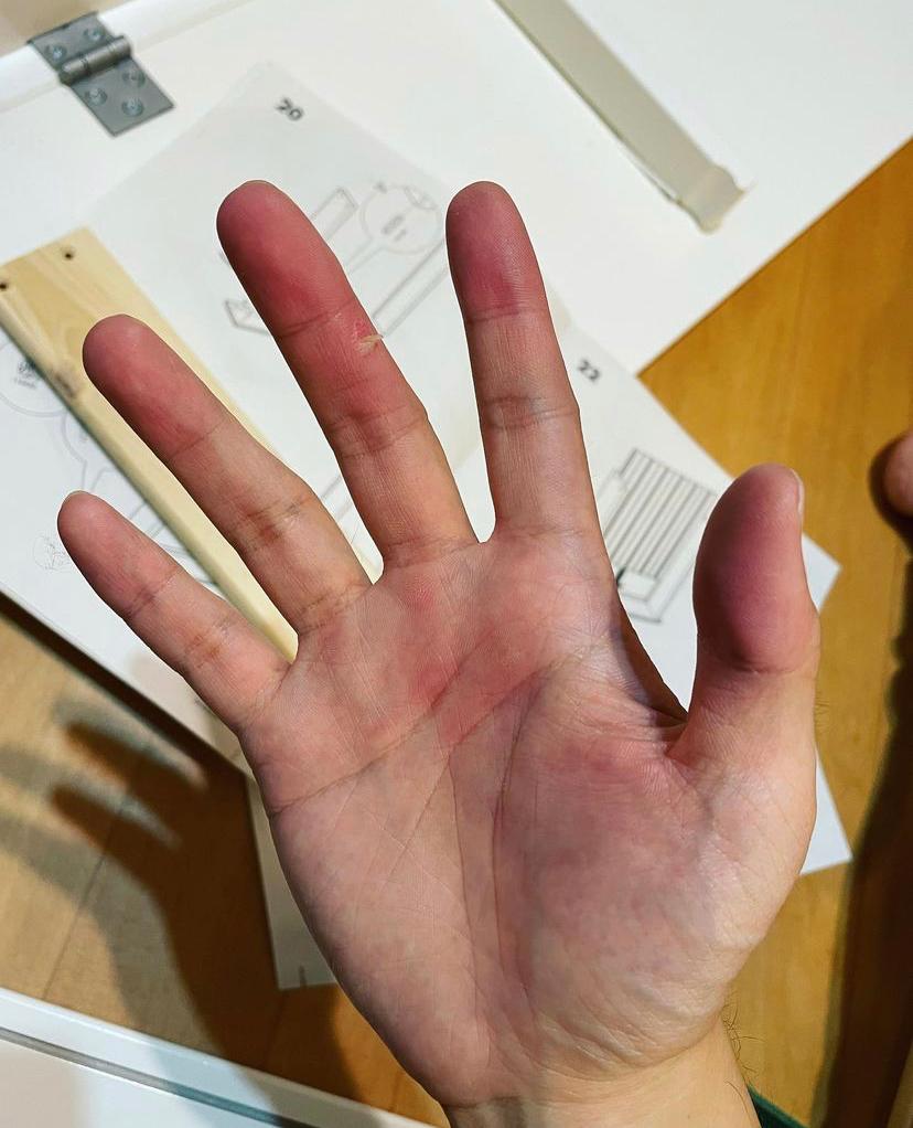 不過就整損右手中指。