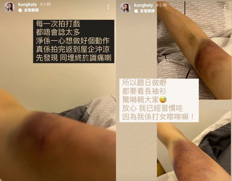 龔嘉欣展示的瘀傷睇見都痛。