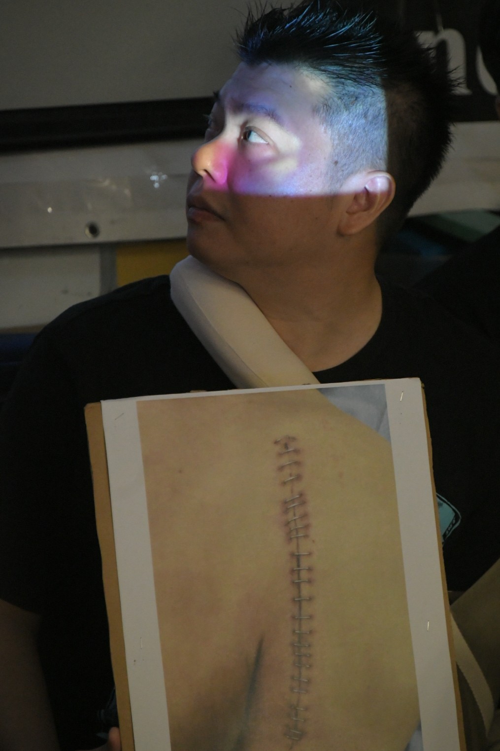 有傷者在記者會上展示受傷相片。
