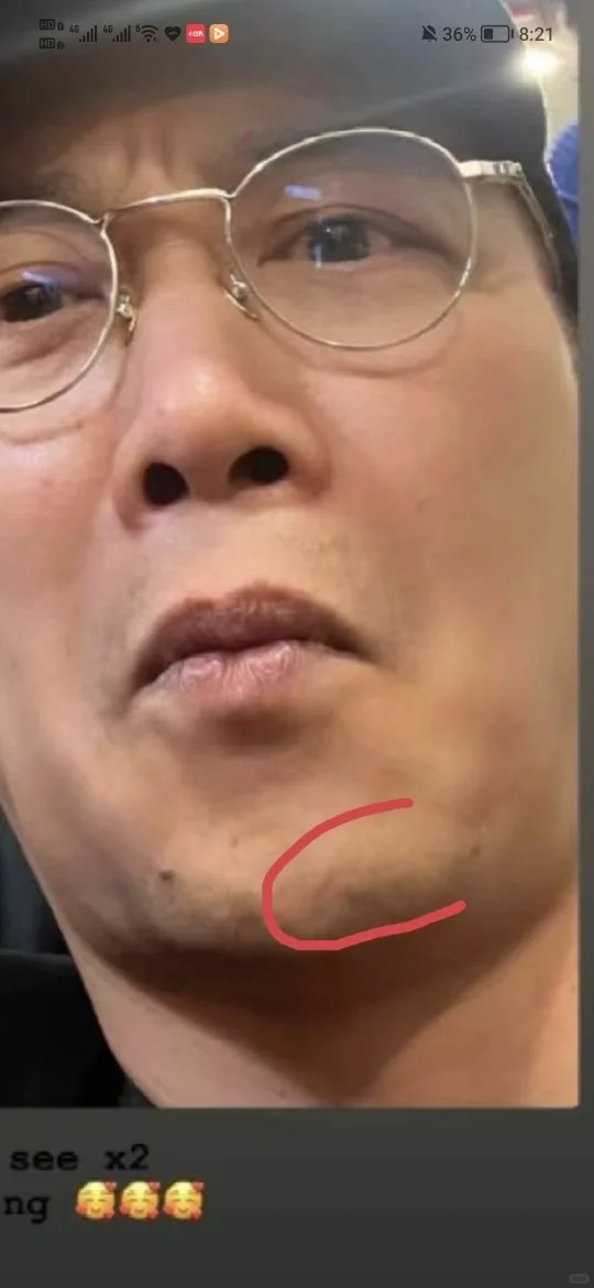 有網民把相片放大，就會看到有陳奕迅下巴有微細的縫針巴痕。