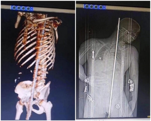 钢筋停留在伍男体内的长度达到1.1米。网图