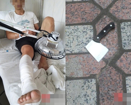 男子被菜刀砍傷右小腿,右脛前肌腱斷裂。網圖